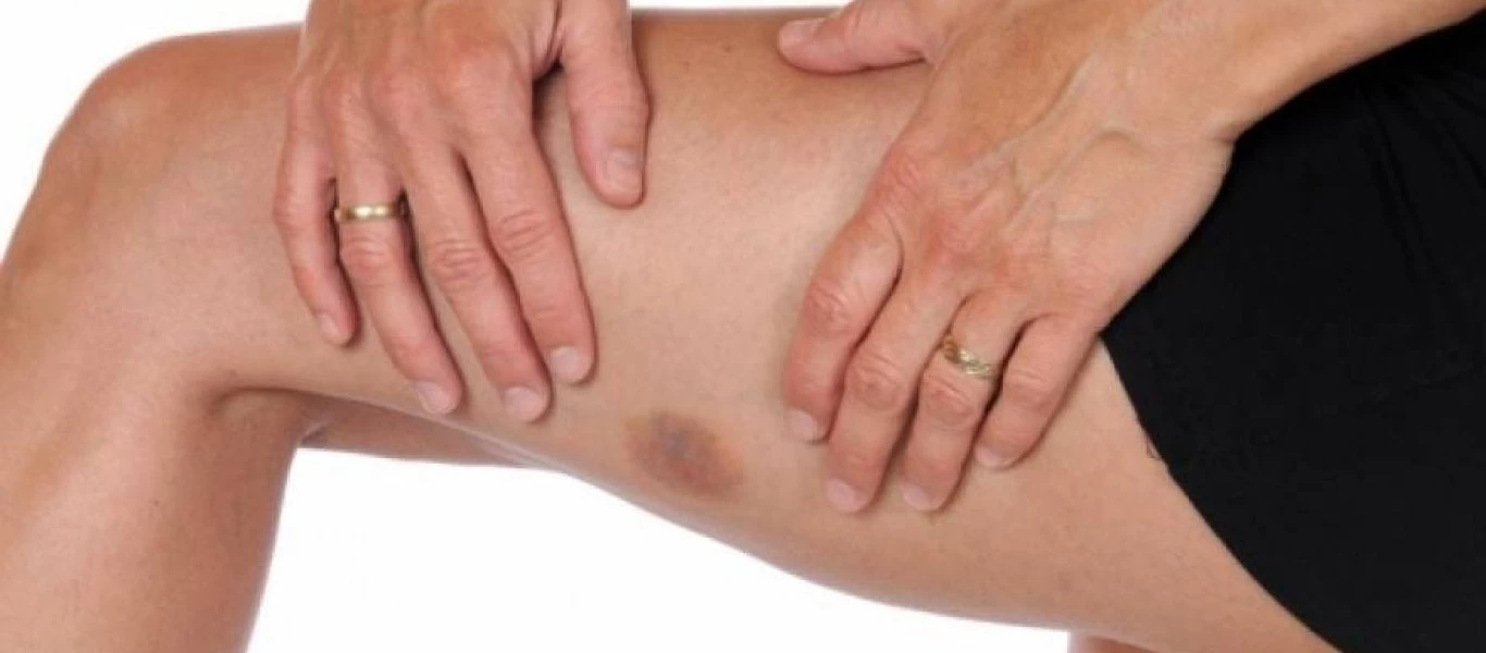 Κάνετε μελανιές «χωρίς λόγο»; – Δείτε τι μπορεί να σας συμβαίνει